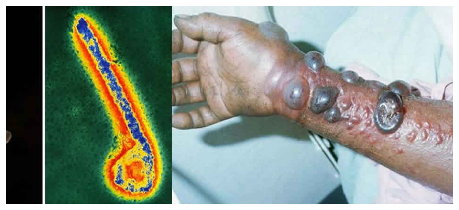 New Virus : Marburg  kills Nine In Rwanda